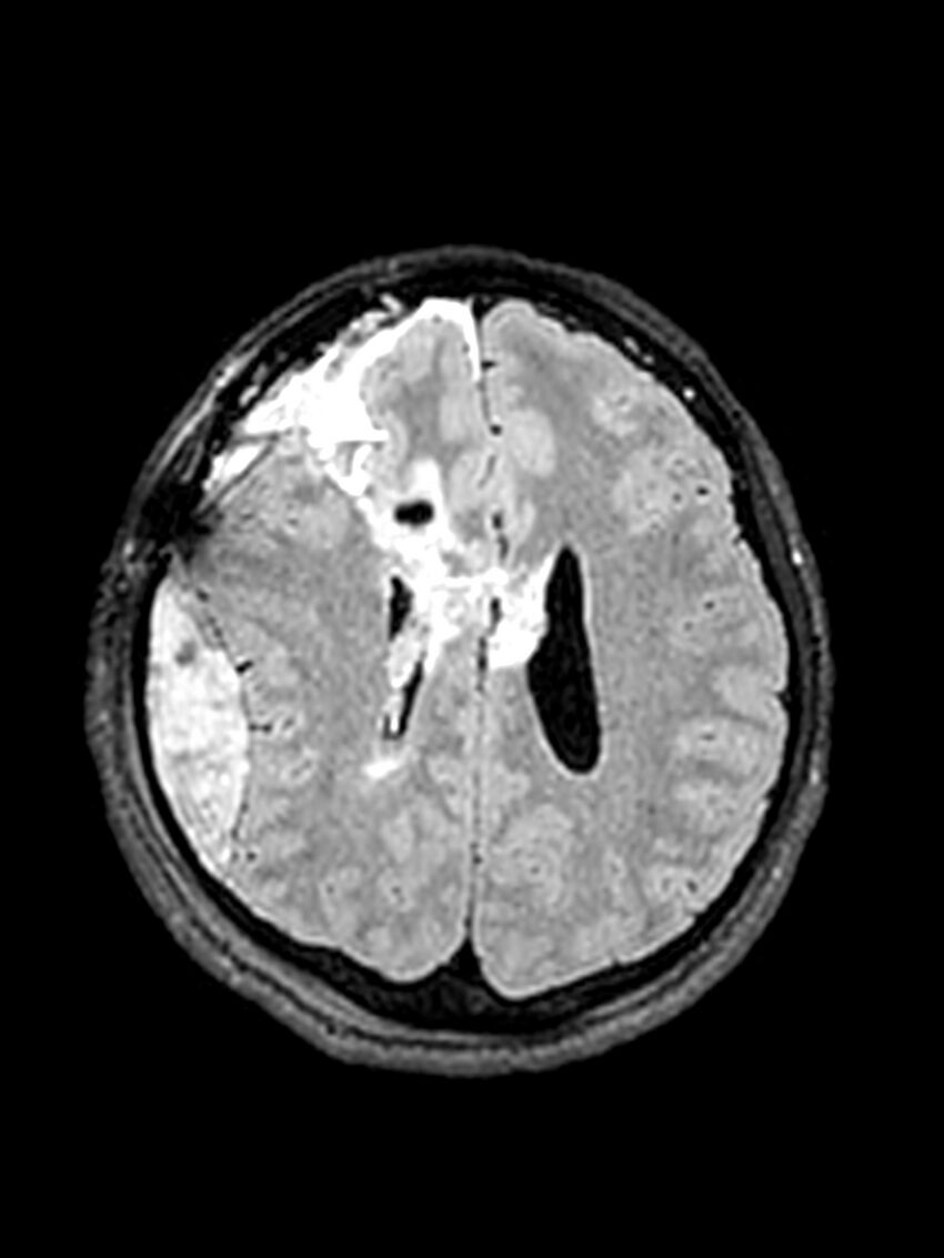 Central neurocytoma (Radiopaedia 79320-92381 Axial FLAIR 64).jpg