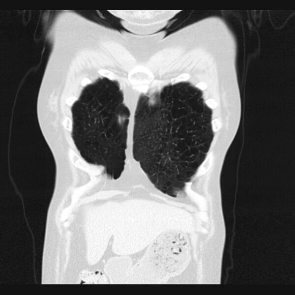 File:Centrilobular pulmonary emphysema (Radiopaedia 24495-24789 Coronal lung window 8).jpg
