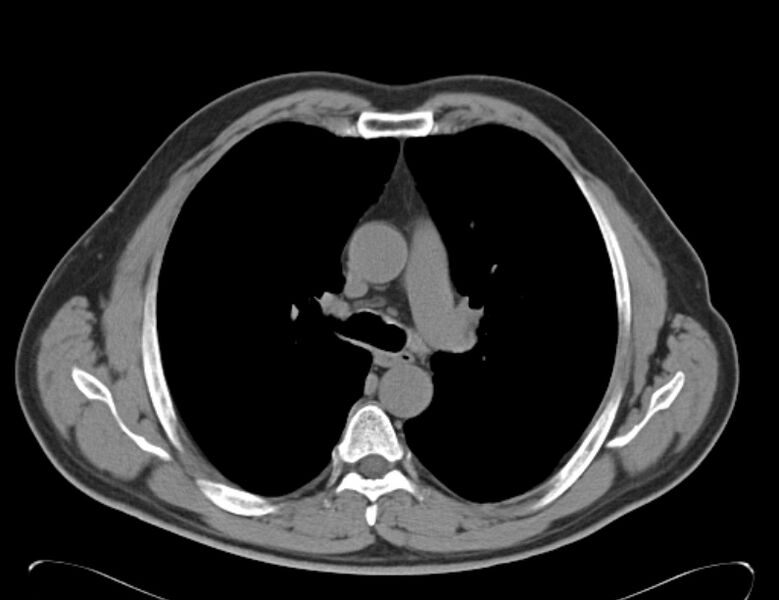 File:Centrilobular pulmonary emphysema (Radiopaedia 26808-26971 Axial non-contrast 18).jpg