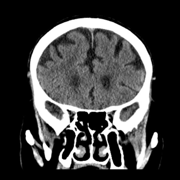 File:Cerebellar hemorrhage (Radiopaedia 27193-27359 Coronal non-contrast 19).jpg