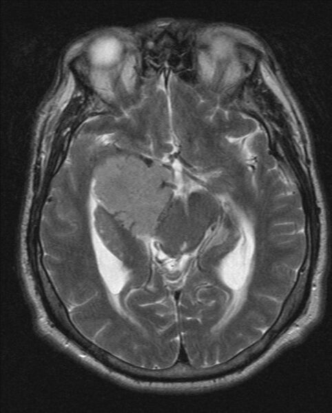 File:Cerebellopontine angle meningioma (Radiopaedia 24459-24764 Axial T2 10).jpg