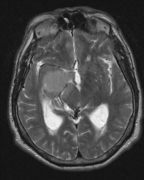 File:Cerebellopontine angle meningioma (Radiopaedia 24459-24764 Axial T2 11).jpg