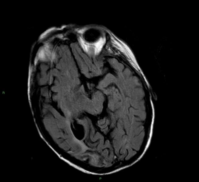File:Cerebral amyloid angiopathy-associated lobar intracerebral hemorrhage (Radiopaedia 58377-65515 Axial FLAIR 16).jpg