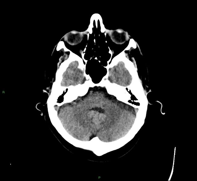 File:Cerebral amyloid angiopathy-associated lobar intracerebral hemorrhage (Radiopaedia 58529-65681 Axial non-contrast 40).jpg