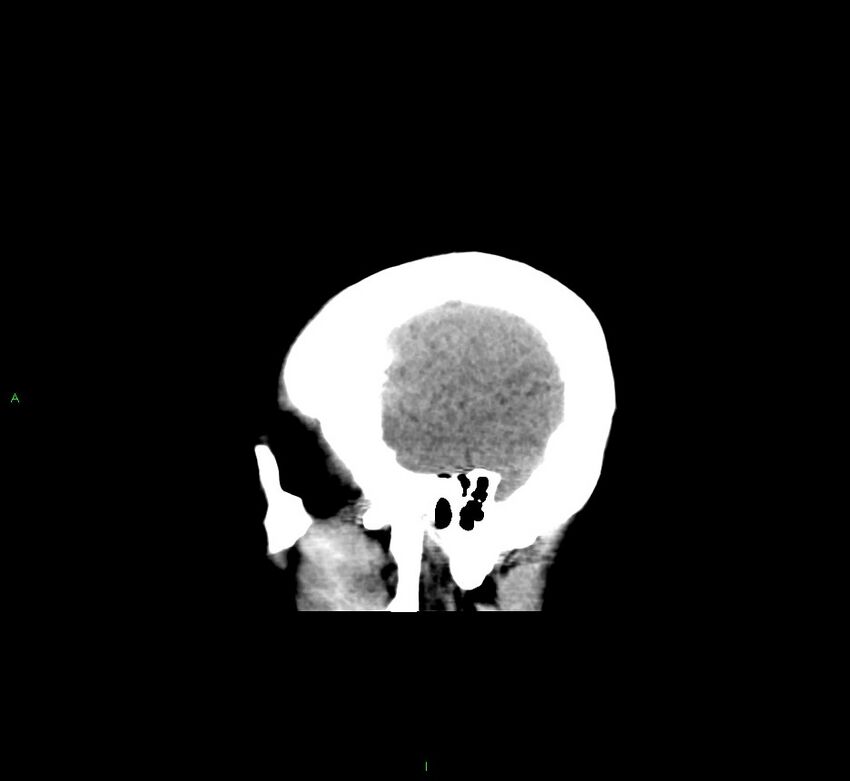 Cerebral amyloid angiopathy-associated lobar intracerebral hemorrhage (Radiopaedia 58529-65681 B 43).jpg