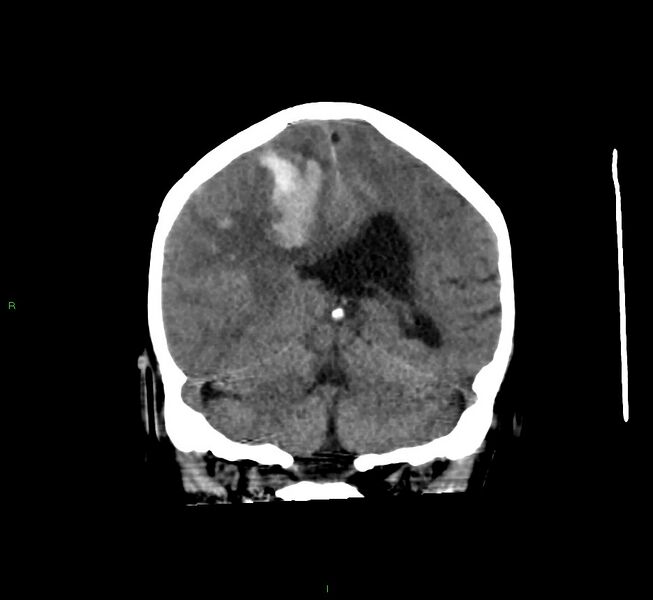 File:Cerebral amyloid angiopathy-associated lobar intracerebral hemorrhage (Radiopaedia 58560-65723 Coronal non-contrast 29).jpg