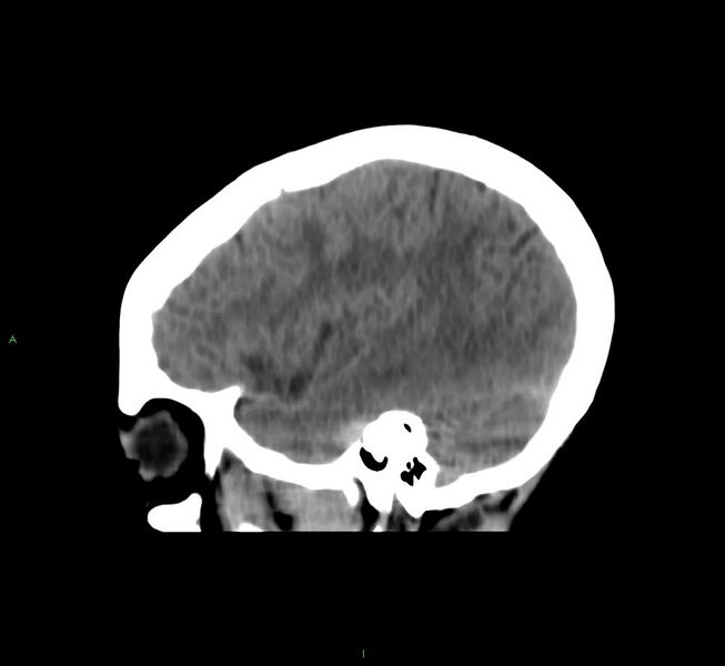 File:Cerebral amyloid angiopathy-associated lobar intracerebral hemorrhage (Radiopaedia 58566-65730 C 39).jpg