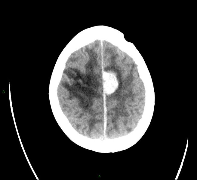 File:Cerebral amyloid angiopathy-associated lobar intracerebral hemorrhage (Radiopaedia 58566-65731 Axial non-contrast 21).jpg