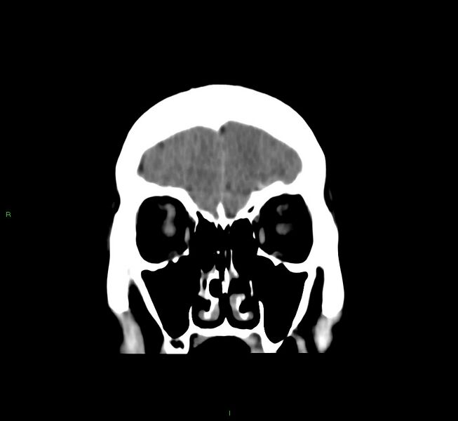 File:Cerebral amyloid angiopathy-associated lobar intracerebral hemorrhage (Radiopaedia 58751-65972 Coronal non-contrast 51).jpg