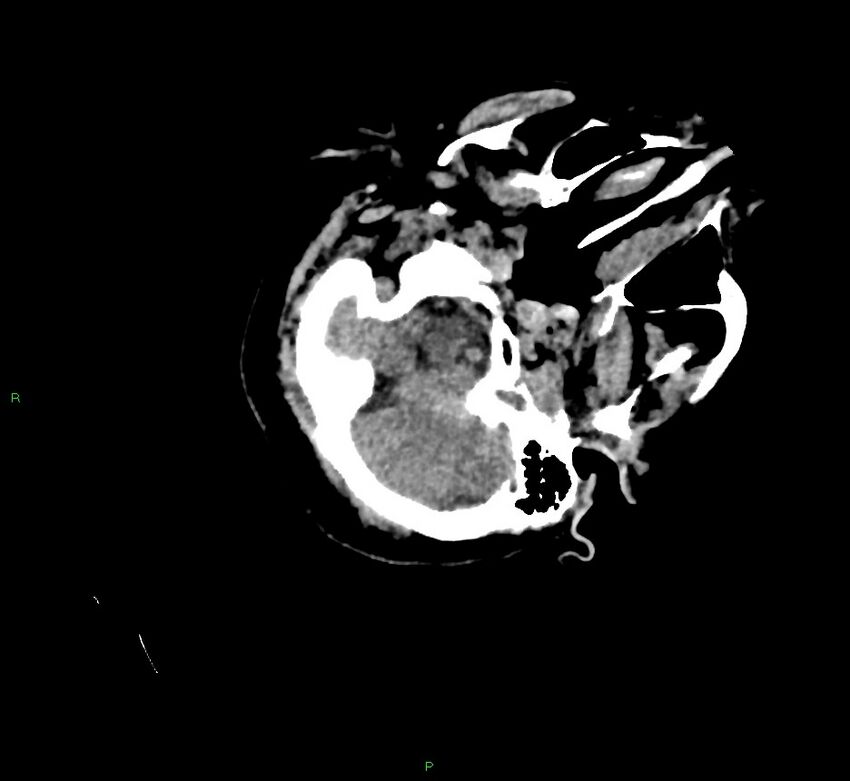 Cerebral amyloid angiopathy-associated lobar intracerebral hemorrhage (Radiopaedia 58757-65979 Axial non-contrast 22).jpg