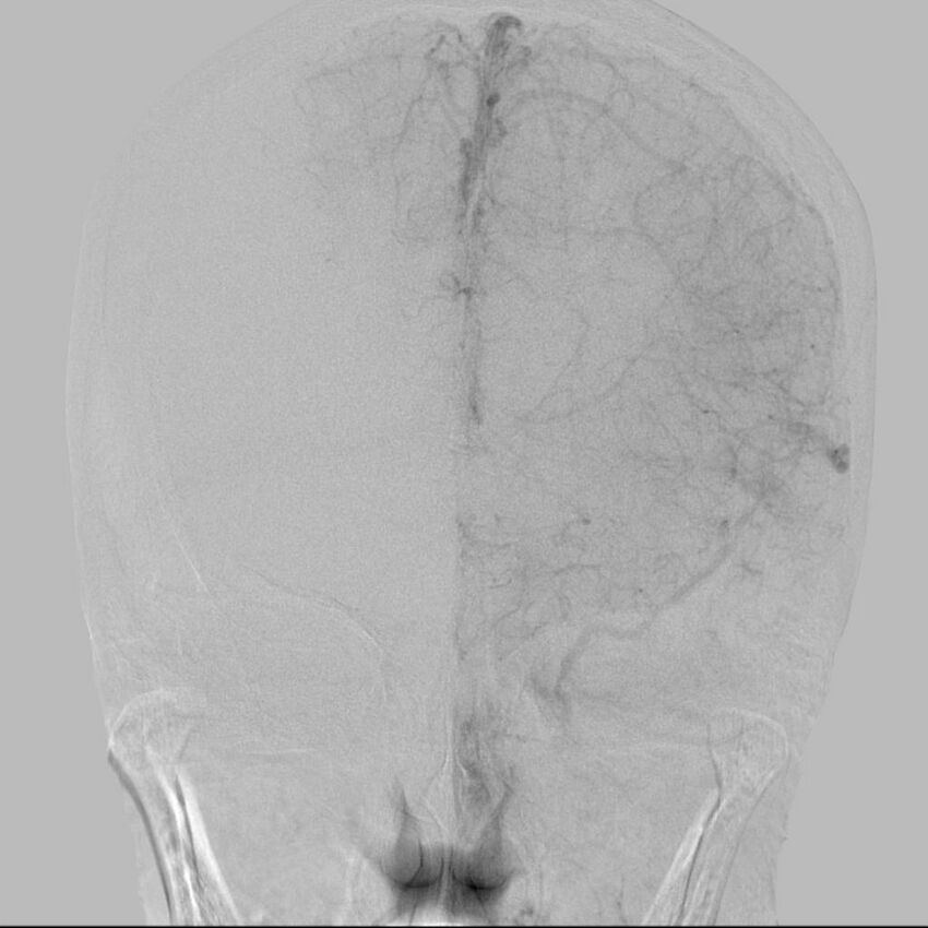Cerebral aneurysm with rupture (Radiopaedia 29933-30458 LT CCA IC 20).jpg