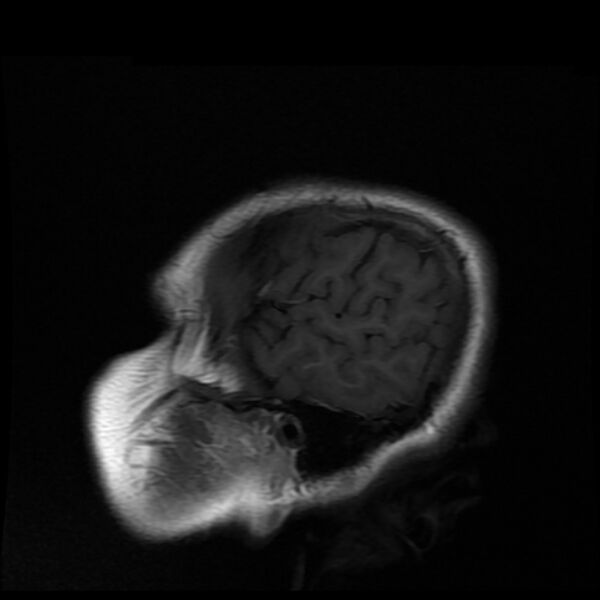 File:Cerebral cavernous malformation (Radiopaedia 44301-47942 Sagittal T1 20).jpg