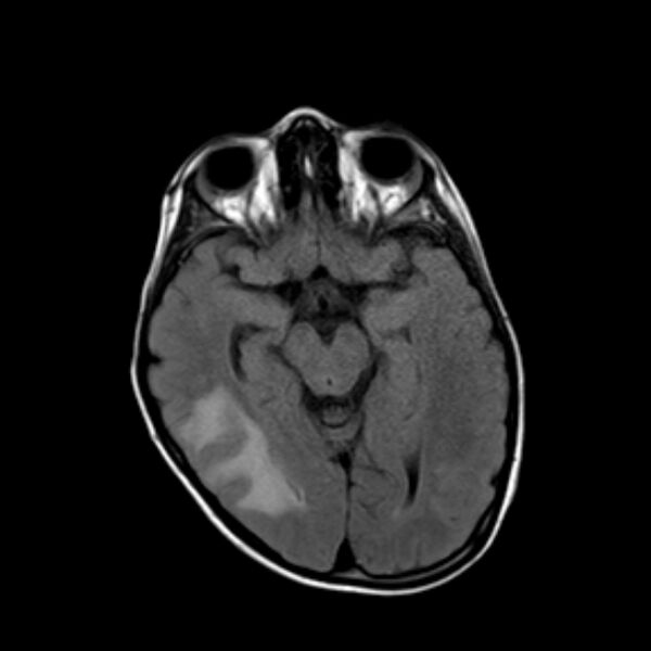 File:Cerebral tuberculoma (Radiopaedia 41152-43932 Axial FLAIR 9).jpg