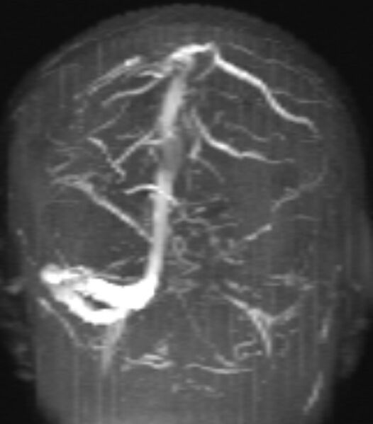 File:Cerebral venous infarct (Radiopaedia 53627-59723 Coronal MRV 1).jpg