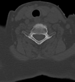 Cervical spine ACDF loosening (Radiopaedia 48998-54070 Axial bone window 43).png