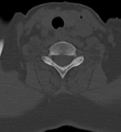 Cervical spine ACDF loosening (Radiopaedia 48998-54070 Axial bone window 45).png