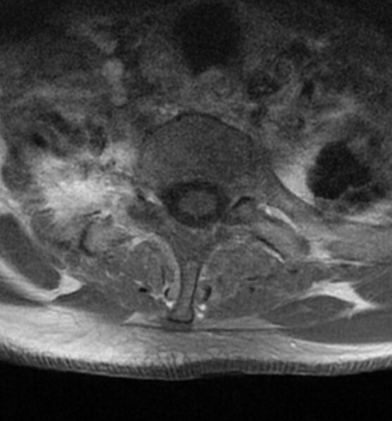 File:Cervical spondylodiscitis (Radiopaedia 81362-95110 Axial T1 C+ fat sat 19).jpg