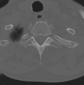 Cervical spondylolysis (Radiopaedia 49616-54811 Axial bone window 48).png