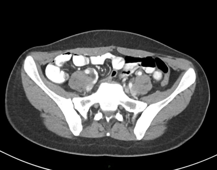 Cesarean scar endometriosis (Radiopaedia 82925-97262 A 61).jpg