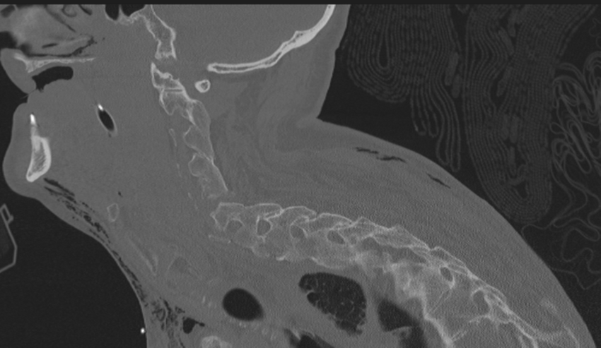 Chalk stick fracture (Radiopaedia 57948-64928 Sagittal bone window 41).png