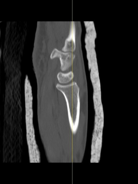 File:Chauffeur's (Hutchinson) fracture (Radiopaedia 58043-65079 Sagittal bone window 7).jpg