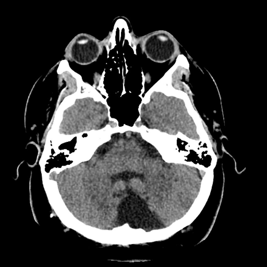 Chiasmatic-hypothalamic juvenile pilocytic astrocytoma (Radiopaedia 78533-91237 Axial non-contrast 16).jpg