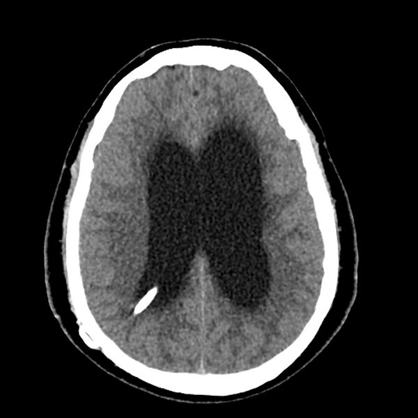 File:Chiasmatic-hypothalamic juvenile pilocytic astrocytoma (Radiopaedia 78533-91237 Axial non-contrast 38).jpg