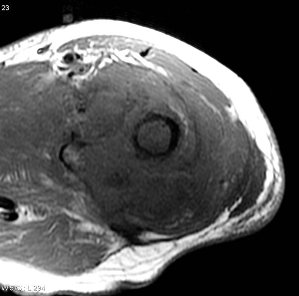 File:Chondrosarcoma with pathological fracture - femur (Radiopaedia 6174-7629 Axial T1 1).jpg