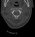 Chordoma (C4 vertebra) (Radiopaedia 47561-52188 Axial bone window 13).png