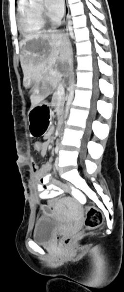 File:Choriocarcinoma liver metastases (Radiopaedia 74768-85766 C 96).jpg