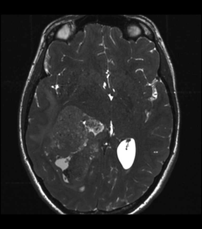 Choroid plexus carcinoma (Radiopaedia 91013-108553 Axial T2 CISS 39).jpg