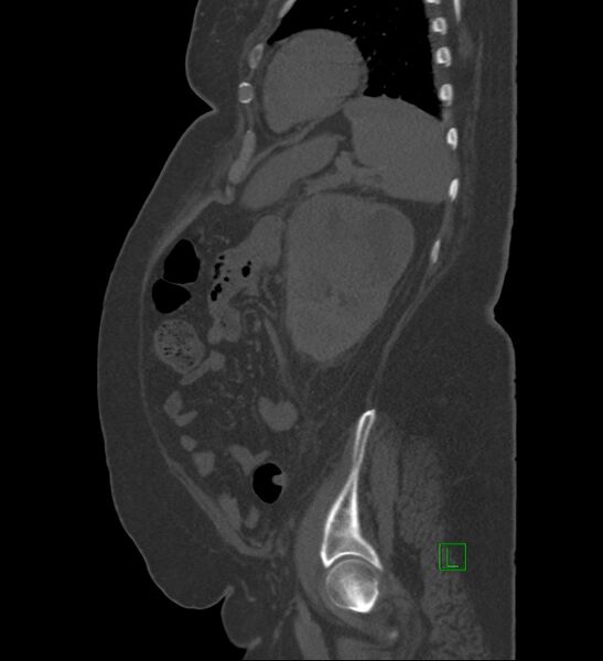 File:Chromophobe renal cell carcinoma (Radiopaedia 84239-99519 Sagittal bone window 25).jpg