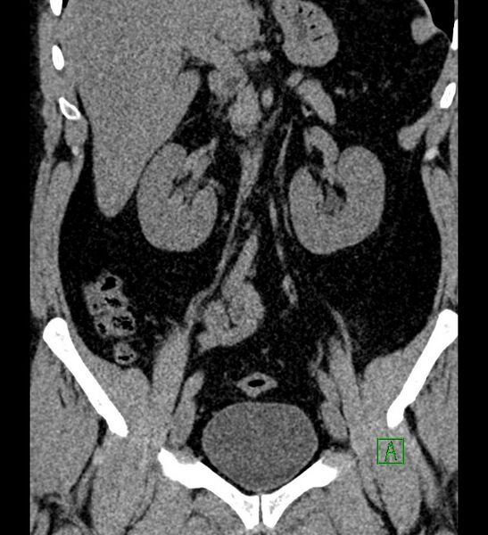 File:Chromophobe renal cell carcinoma (Radiopaedia 84286-99573 Coronal non-contrast 87).jpg
