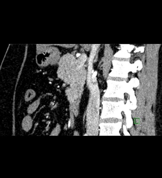 File:Chromophobe renal cell carcinoma (Radiopaedia 84286-99573 F 93).jpg