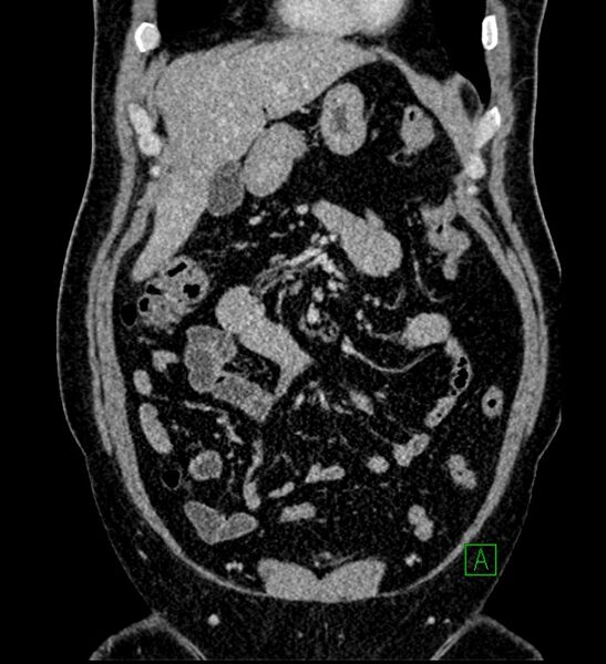 File:Chromophobe renal cell carcinoma (Radiopaedia 84286-99573 H 52).jpg