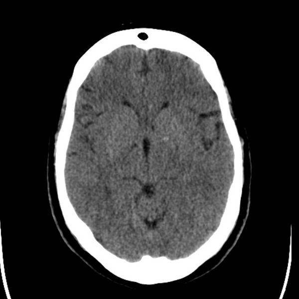 File:Chronic bilateral occipital lobe infarcts (Radiopaedia 31276-31996 Axial non-contrast 19).jpg