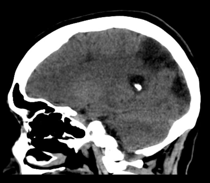 File:Chronic bilateral occipital lobe infarcts (Radiopaedia 31276-31996 C 25).jpg