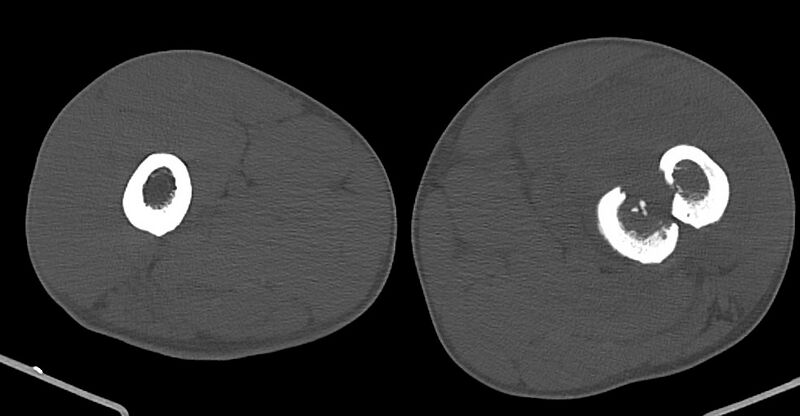 File:Chronic osteomyelitis (with sequestrum) (Radiopaedia 74813-85822 Axial non-contrast 82).jpg