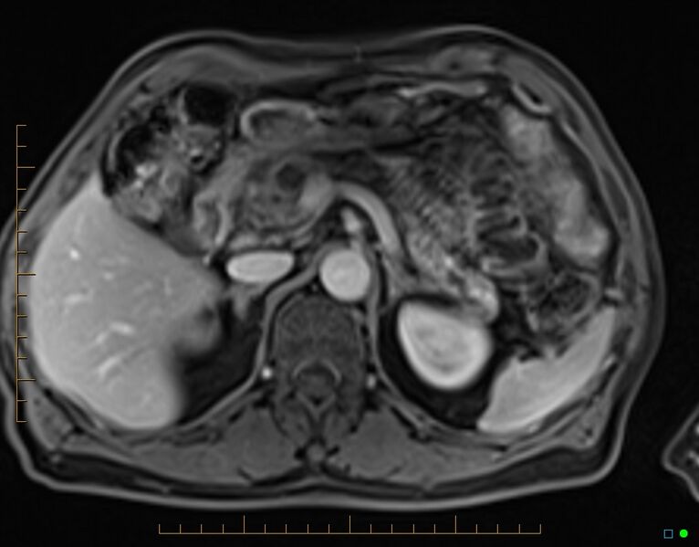 File:Chronic pancreatitis (Radiopaedia 17014-16716 Axial T1 C+ fat sat 26).jpg