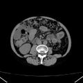 Chronic pancreatitis (Radiopaedia 23132-23172 Axial non-contrast 44).jpg