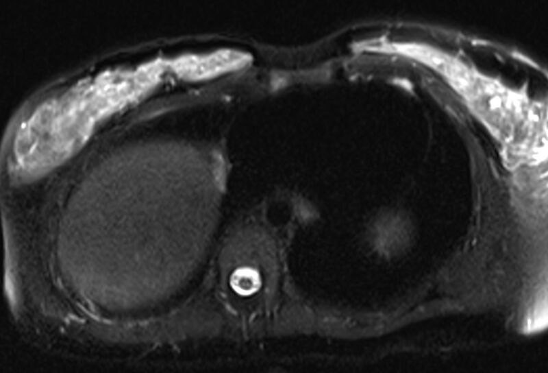 File:Chronic pancreatitis - pancreatic duct calculi (Radiopaedia 71818-82250 Axial T2 fat sat 3).jpg