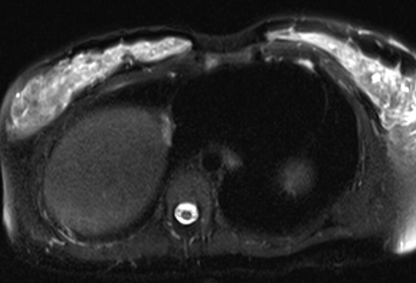 Chronic pancreatitis - pancreatic duct calculi (Radiopaedia 71818-82250 Axial T2 fat sat 3).jpg