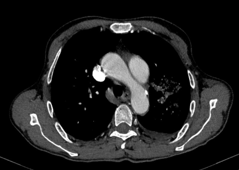 File:Chronic pulmonary embolism with bubbly consolidation (Radiopaedia 91248-108850 C+ arterial phase 43).jpg
