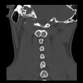 Clay-shoveler fracture (Radiopaedia 22568-22590 Coronal bone window 26).jpg
