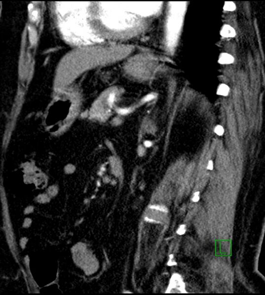 File:Clear cell renal cell carcinoma (Radiopaedia 85004-100537 D 26).jpg