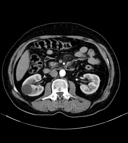 File:Clear cell renal cell carcinoma (Radiopaedia 85006-100539 B 40).jpg