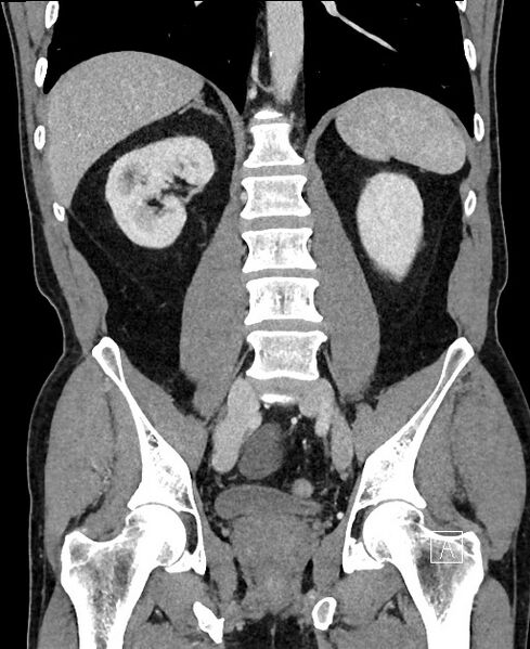 File:Closed loop small bowel obstruction - internal hernia (Radiopaedia 57806-64778 A 75).jpg