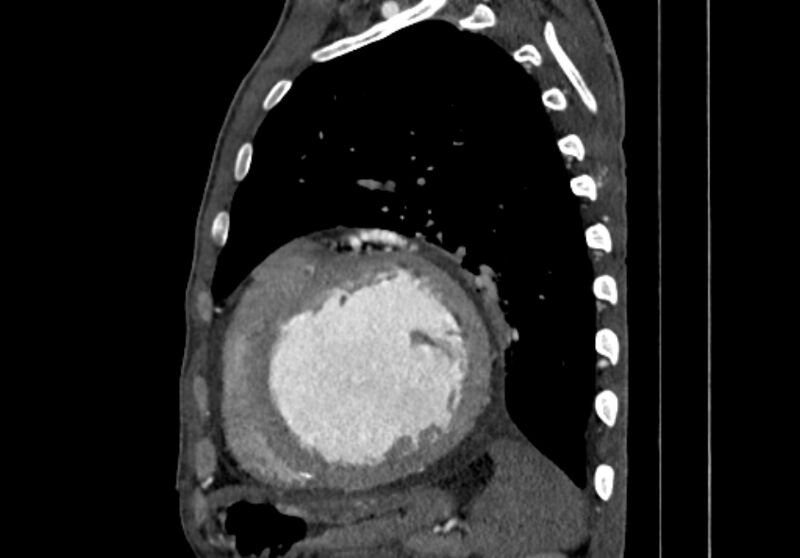 File:Coarctation of aorta with aortic valve stenosis (Radiopaedia 70463-80574 B 147).jpg