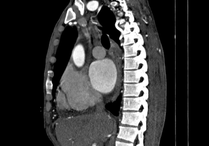 File:Coarctation of aorta with aortic valve stenosis (Radiopaedia 70463-80574 B 36).jpg