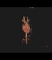 Coarctation of the aorta (Radiopaedia 43373-46729 3D reconstruction 25).jpg